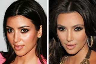 Kim Kardashian Plastic Surgery