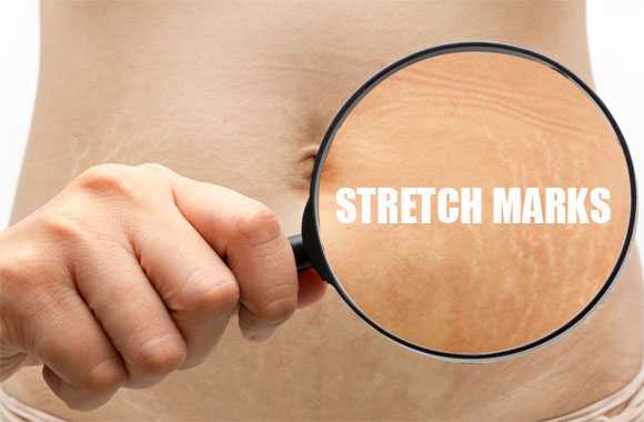 Tips Menyamarkan Stretch Mark