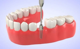 Cấu tạo của răng Implant ra sao-2