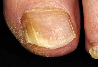 Home remedies to kill the fungus