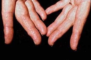 amiloidosis pada tangan