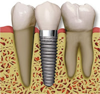 http://www.dental-clinic-delhi.com/dental-implants.html