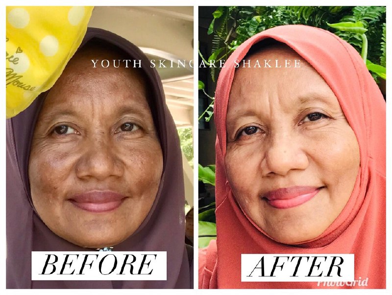 set jeragat shaklee pengalaman guna youth shaklee testimoni serum youth shaklee harga serum youth shaklee benzoil peroksida jeragat testimoni serum shaklee cara hilangkan jeragat, cara hilangkan jerawat dengan cepat, radiance C+E, Uncategorized, Youth Skincare APA ITU JERAGAT ATAU PIGMENTASI? 3 Jenis Hyperpigmenation Apa yang menyebabkan hyperpigmetation jadi makin teruk?  Ramai yang tahu Shaklee dah keluarkan produk skincare mereka sendiri selepas 8 tahun kajian. Alhamdulillah. Dan ju sendiri merupakan antara pengguna setia Youth . Memang banyak sangat perubahan positif bila guna Youth ni tau, yang jerawat dah hilang jerawat, yang kulit kusam dah jadi berseri dan yang jeragat dah jadi makin licin dan hilang jeragat. wah , hebat kan?  Untuk hilangkan jeragat , bahan yang kena uolls kena cari ialah bahan yang mencerahkan kulit atau Brightening Agent dan sebelum tu kena tahu dulu apa punca jeragat ni.  APA ITU JERAGAT ATAU PIGMENTASI? Jeragat atau pigmentation adalah kesan akibat penghasilan melanin yang berlebihan. Melanin ni benda baik sebenarnya, fungsinya macam benteng yang halang sinar UV dari serang sel kulit. Korang tahu kan, sinar UV ni boleh musnahkan kolagen dan elastin, dan galakkan radikal bebas yang boleh rosakkan sel.  Biasanya akan muncul tompok-tompok hitam dan gelap.  3 Jenis Hyperpigmenation Melasma – jeragat yang disebabkan oleh perubahan hormon dan biasanya naik sewaktu mengandung. Biasanya kat muka dan badan. Sunspots – jeragat disebabkan terdedah kepada matahari pada waktu yang sangat lama. Juga dipanggil liver spots atau solar lentigines. Biasanya pada muka dan tangan. Post-Inflammatory Hyperpigmentation – adalah kesan akibat kecederaan pada kulit. contohnya parut hitam kesan peninggalan jerawat. Apa yang menyebabkan hyperpigmetation jadi makin teruk? Sun exposure akan tingkatkan penghasilan melanin. Makin banyak melanin, makin banyaklah pigmentasi/jeragat/tompok hitam pada kulit.  Apa yang menyebabkan hyperpigmentation/jeragat/tompok hitam?