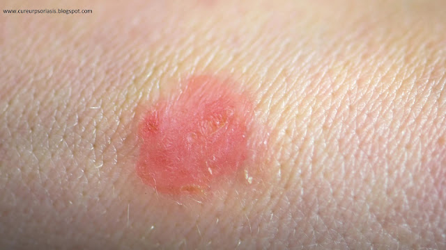Mild Psoriasis