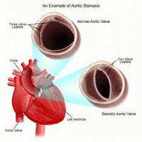 What is Rheumatic Fever Caused By