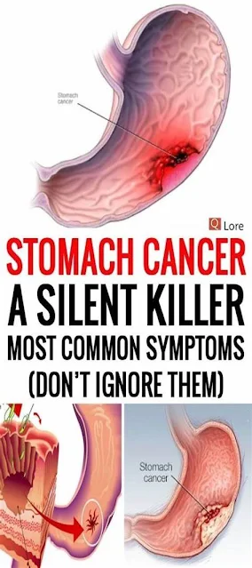 Stomach Cancer A Silent Killer – Most Common Symptoms (Don’t Ignore Them)