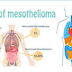 Standard And Experimental Mesothelioma Treatments