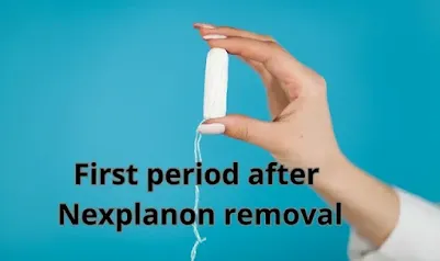 First Period After Nexplanon Removal