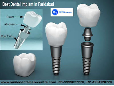 Dental Implant Clinic in Faridabad