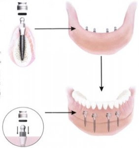 Trồng răng Implant tự nhiên như răng thật