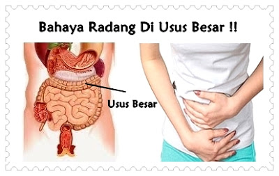 BOLEHKAH MZ & SCT ATASI KERACUNAN MAKANAN-ULSER-RADANG USUS? JOM BACA ! I Aafiyat Lifestyle