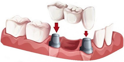 Các phương pháp trồng răng sứ thẩm mỹ hiện nay 2