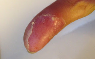 Bad finger of lupus and raynaud sufferer