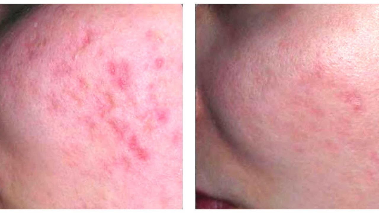 Chicken Pox Scar Removal Before And After