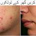 How Remove Red Acne - Complete Home Remedy