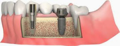 Cấy ghép răng Implant có ích lợi gì ?