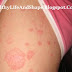 Home Remedies for Red Rashes and Itchy Skin