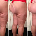 Silicone sai do lugar e deixa mulher com bumbum 'invertido'