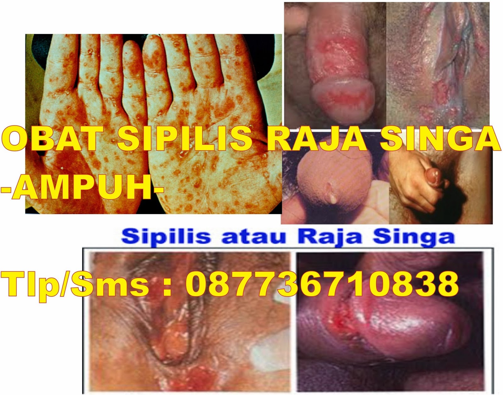 Cara mengobati sipilis Obat Asli aman dan terbukti