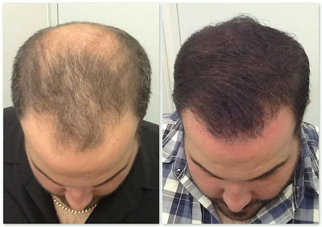 Hair Transplant