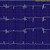 Síncope y ECG (MIR 2011)