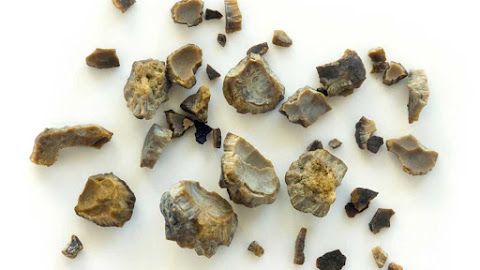 Types of Calcium Oxalate Kidney Stones