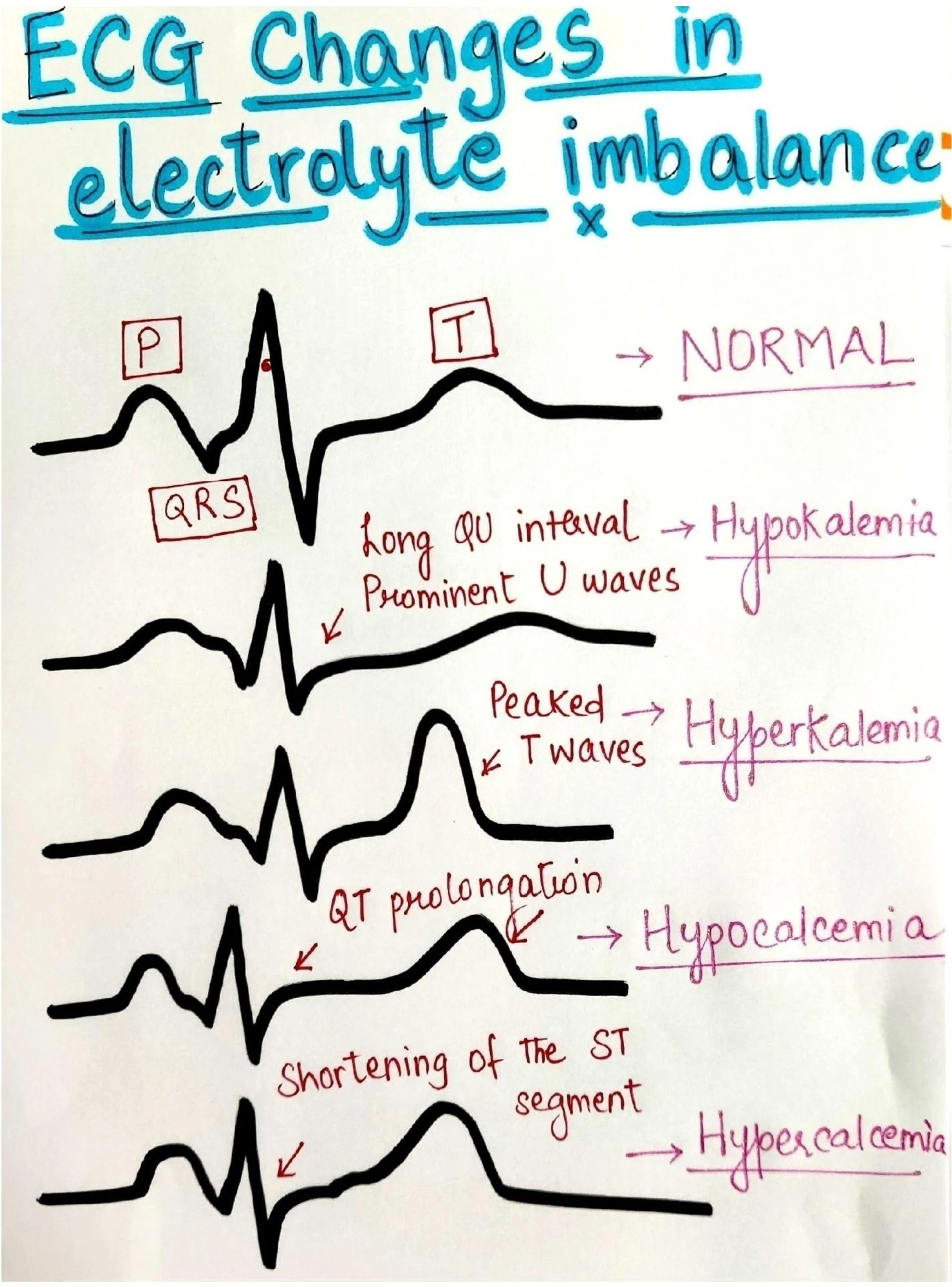 ECG Changes in Electrolyte Imbalance | Visual Guide for Medical Students