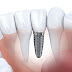Trường hợp nào nên trồng răng implant