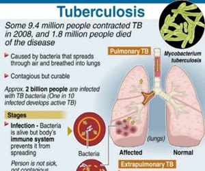 Penyakit Tuberkulosis TBC