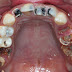 Nguyên nhân gây sâu răng