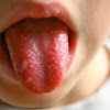 What You Should Know about Oral Thrush in Babies