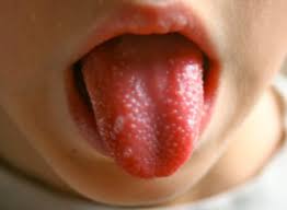 What You Should Know about Oral Thrush in Babies