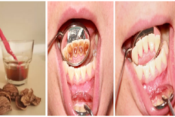 Kalo Tau Semudah ini Gak Perlu Lagi ke Dokter Gigi, Begini Cara Bersihkan Plak/Karang Gigi yang Membandel