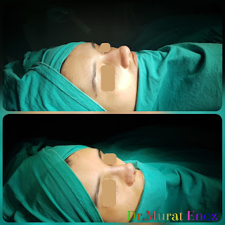 Thick Skin Bulbous Tip Rhinoplasty, Thick Skinned Nose Job, Female Rhinoplasty, Deviated Nose Aesthetic, Ethnic Rhinoplasty