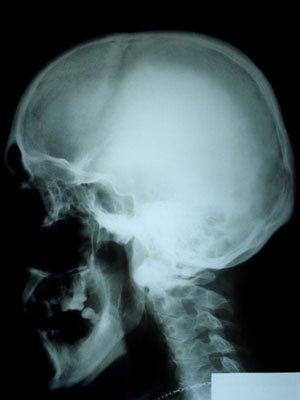 Brain X ray6