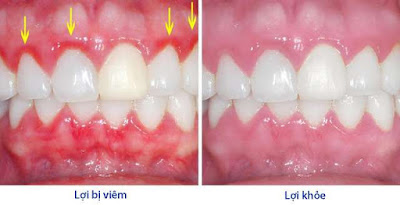  Cách điều trị viêm lợi khi đang cho con bú