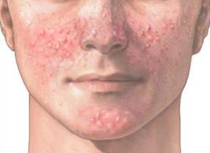 Acne Vulgaris (Jerawat)