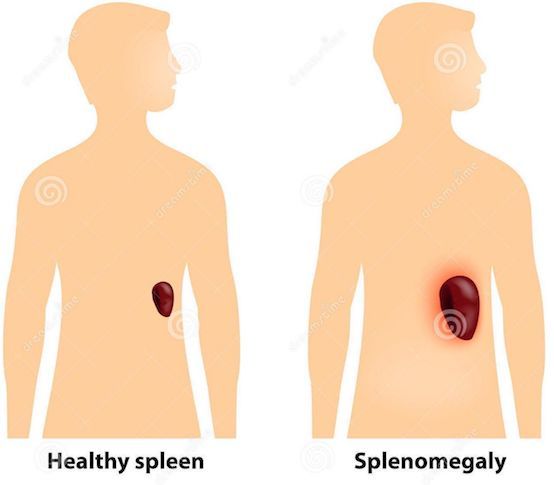 Hepatolineal syndrome