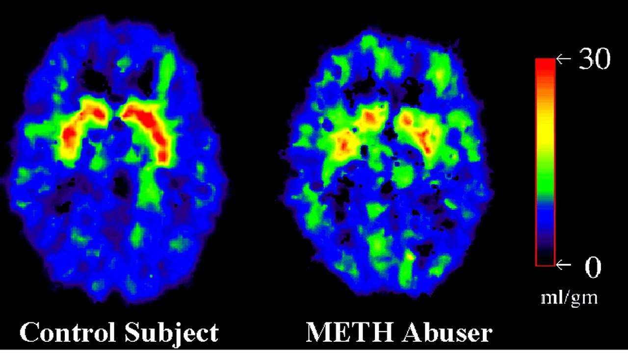 Long Term Effects Of Methamphetamine