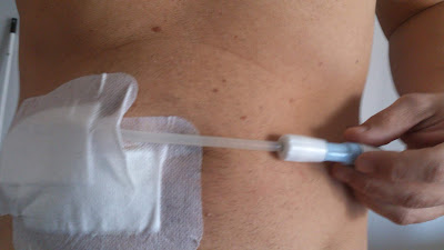 Cateter en la barriga o peritoneo