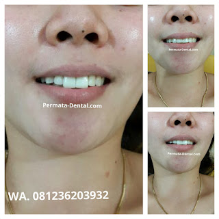 veneer bikin gigi kelinci di bali| gigi kelinci bagus | gigi kelinci denpasar| gigi kelinci ngurah rai |  gigi kelinci jimbaran| pasang gigi kelinci nusa dua | pasang gigi kelinci bagus | pasang gigi kelinci murah | gigi kelinci di ahli gigi | gigi kelinci permanen | pasang gigi kelinci aman | pasang gigi kelinci cepat| Harga pasang gigi kelinci   | pasang gigi mudah | pasang gigi kelinci cantik| foto gambar gigi kelinci sebelum dan sesudah | gigi kelinci promo | trend foto gambar gigi kelinci | bunny smile