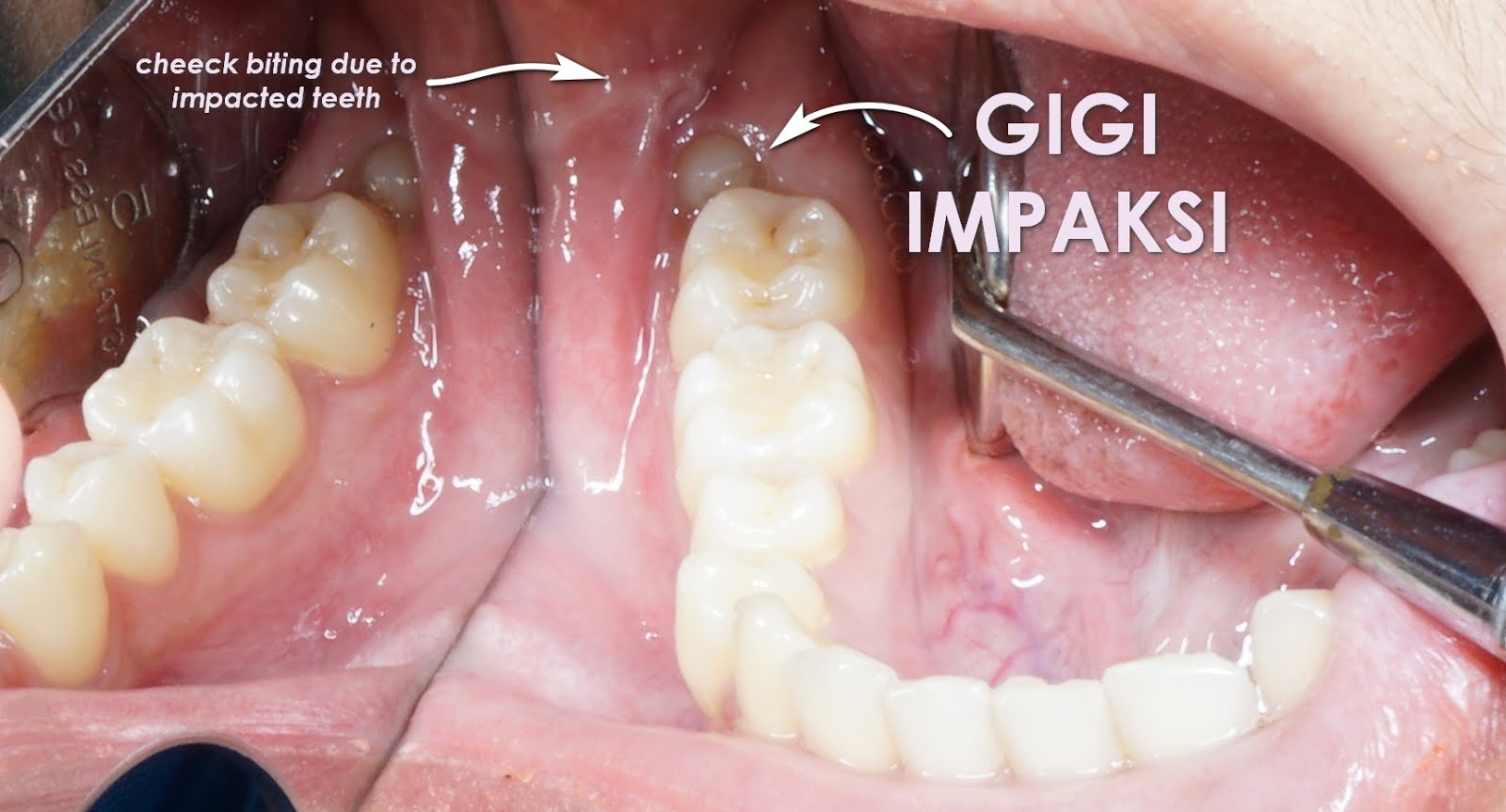 Sakit Gigi Gusi Bengkak: Apa Obatnya dan Cara Mengatasinya?