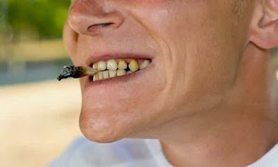 penyebab gigi berlubang Rokok secara tidak langsung akan menyebabkan gigi berlubang dan sakit gigi