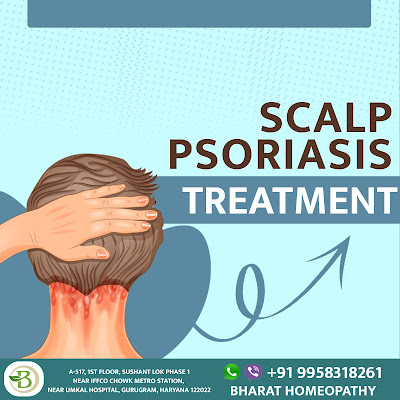 Scalp Psoriasis Treatment