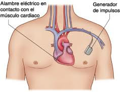 Imágen sobre la colocación del marcapasos