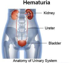 Hasil gambar untuk Hematuria dan cara menanggulanginya