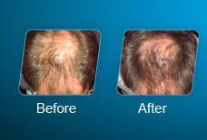 Regrowth of Hair after Propecia