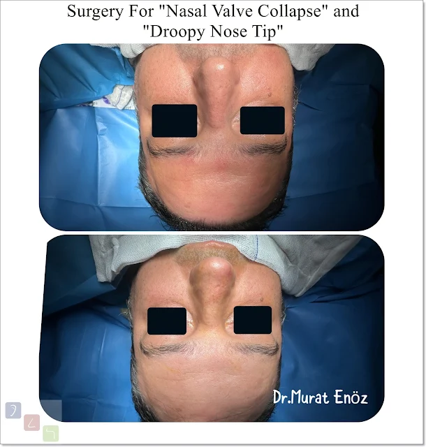 Nostril collapse,Nasal valve collapse,Nasal valve,Alar collapse,Repair of nasal valve collapse,Nasal valve collapse surgery,Nasal valve collaps,Treatment of nasal valve collapse,