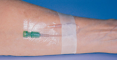 foto tangan  di  infus  di  rumah sakit Akuntt com 