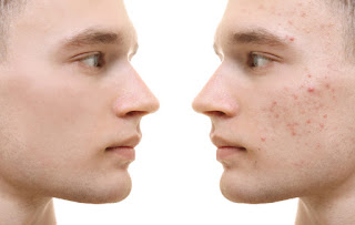 4 Simple Methods to Clear Up Acne Scars How to Get Rid of Acne Scars